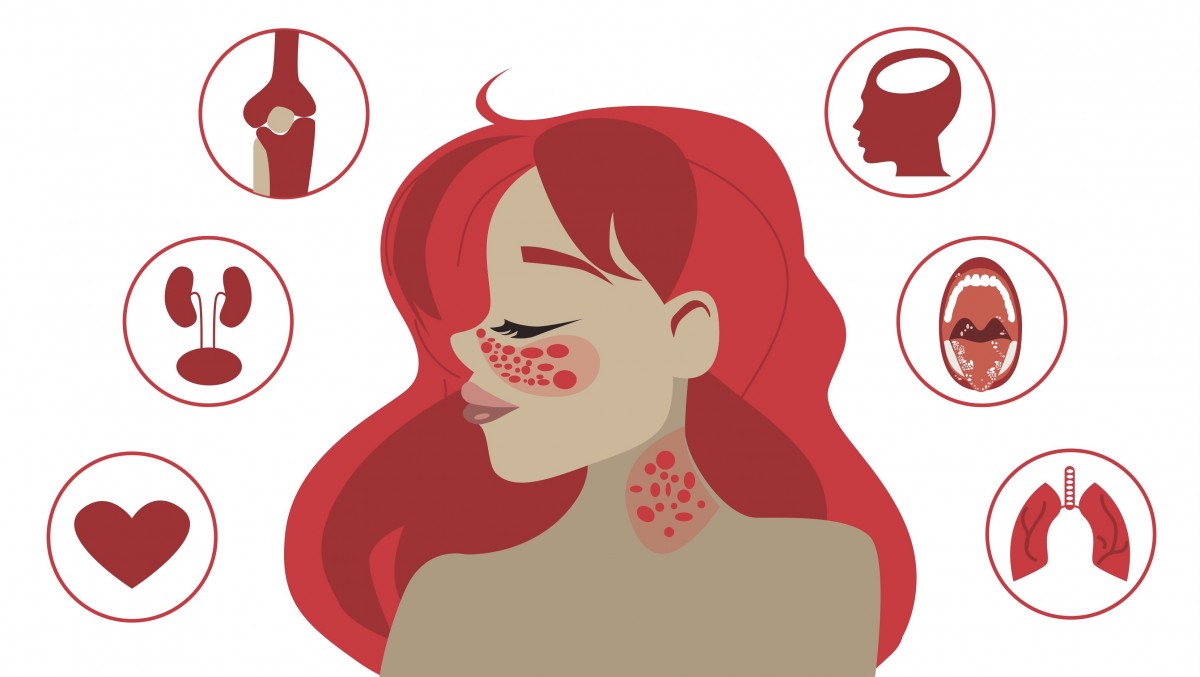 Lupus